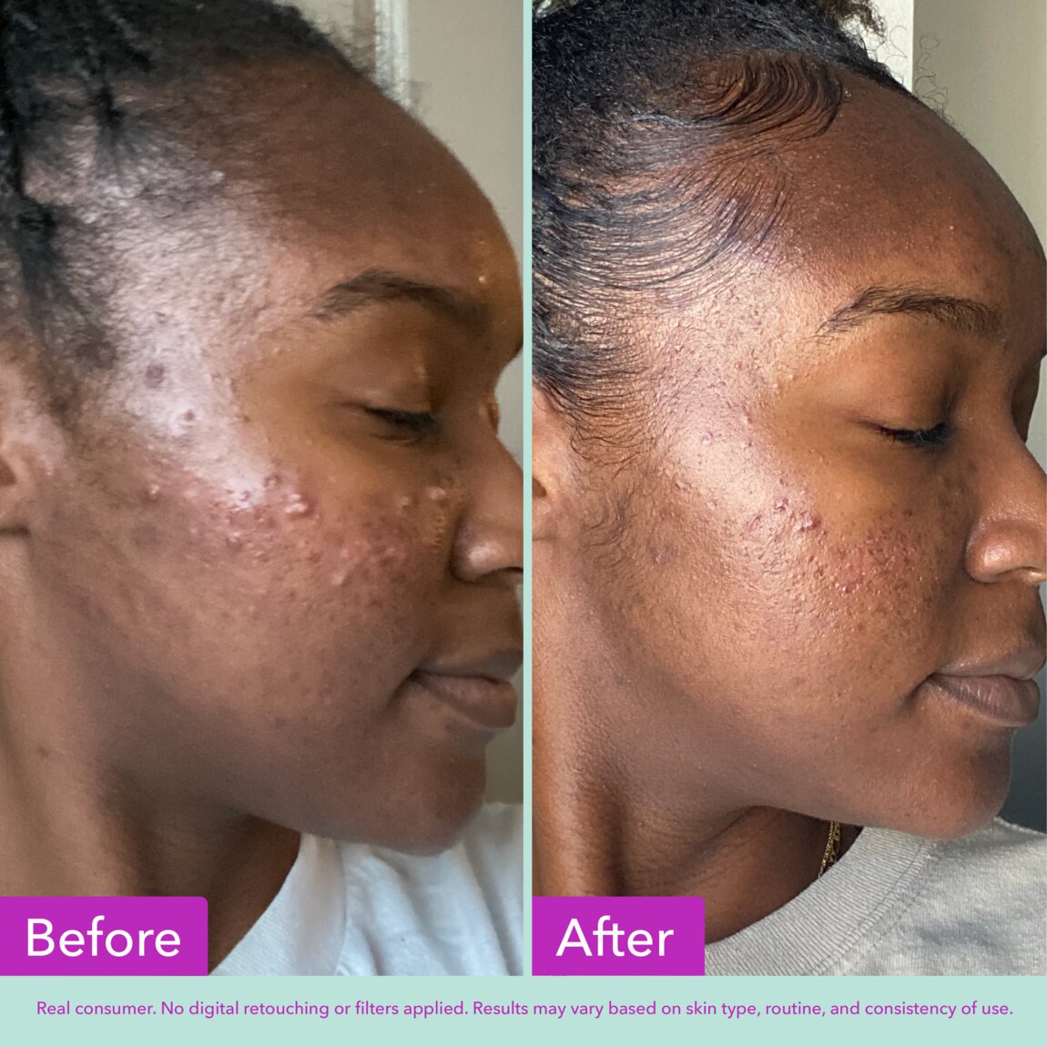 acne-foaming-cleanser-e5 zb_p.jpg