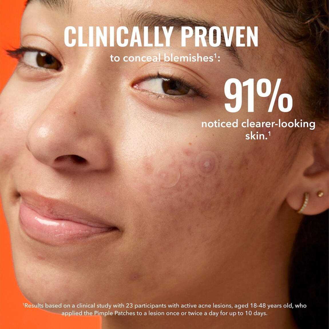 pimple-patches-t0 zb_p.jpg